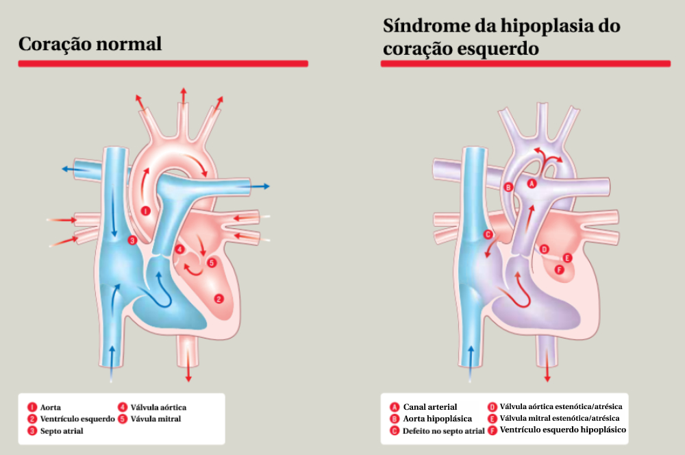 Ilustração mostra um coração normal e um com síndrome da hipoplasia do coração esquerdo